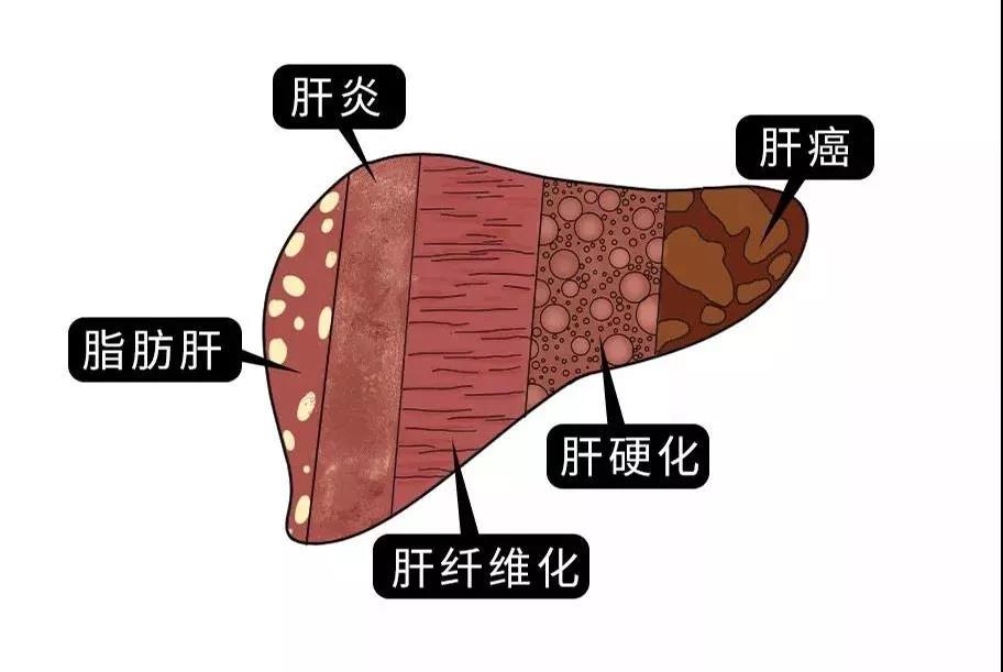 脂肪肝的最大敌人不是肥胖,答案竟是这样! 脂肪肝的最大敌人不是肥胖,答案竟是这样!