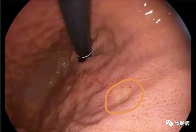 医生总结了3位年轻胃癌患者的病例：30岁不到的他们到底干啥了？