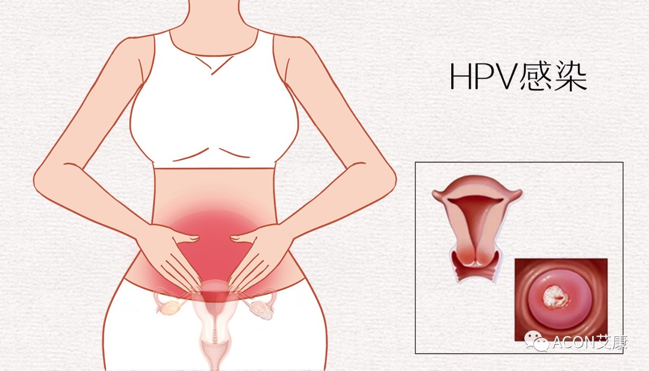 HPV转阴其实很简单， 女性必知的宫颈癌真相