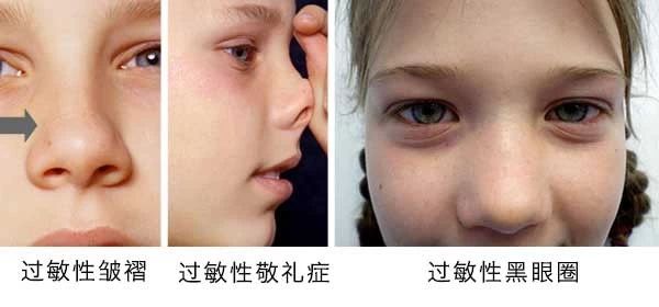 过敏性鼻炎会让孩子变傻?!家长该如何应对 过敏性鼻炎会让孩子变傻?!家长该如何应对